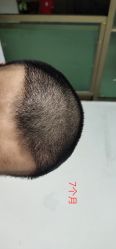 点击看大图 -大麦微针植发全国连锁