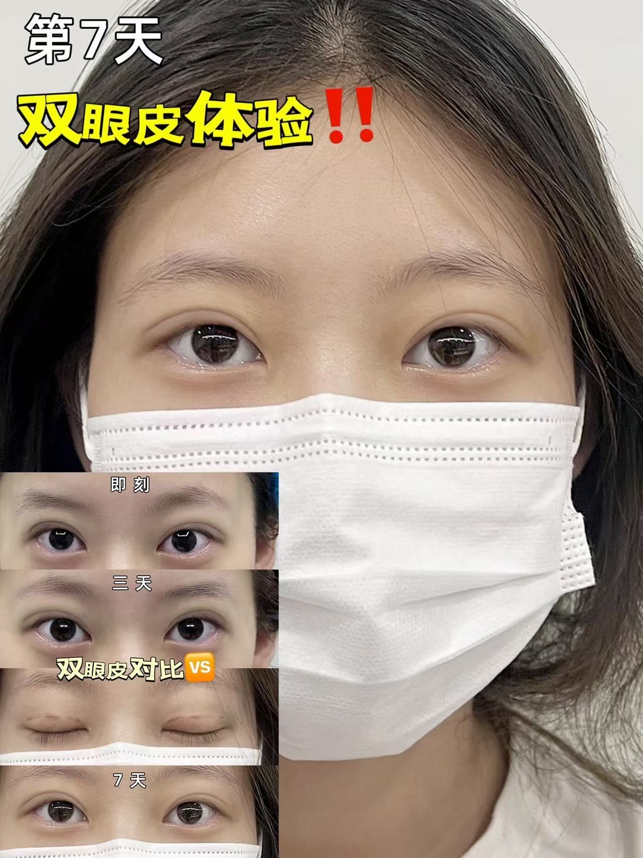 看我之前照片(第2张),眼睛无神,提肌无力,上眼皮松弛