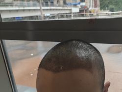 -碧莲盛·不剃发植发