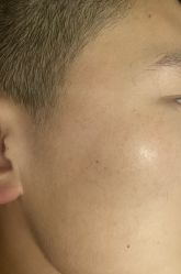 体验前-清疣美疣·痣·斑净肤中心