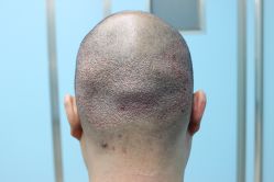 点击看大图 -大麦微针植发丨全国连锁