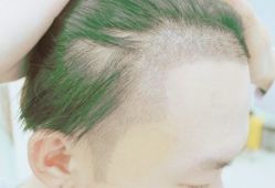 -大麦微针植发丨全国连锁