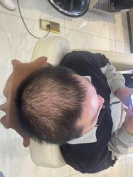 点击看大图 -大麦微针植发丨全国连锁