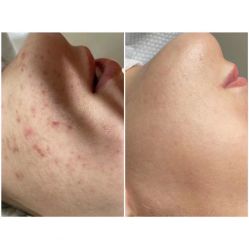 -美肤盾祛痘·问题肌头疗管理中心