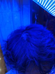 -碧莲盛·不剃发植发