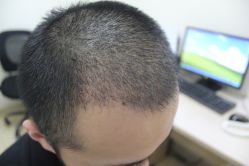 点击看大图 -大麦微针植发丨全国连锁