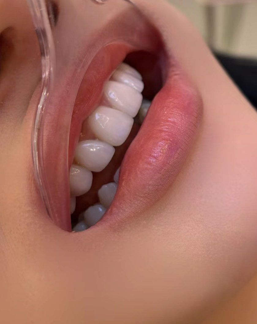 亮白牙齿自然闪耀