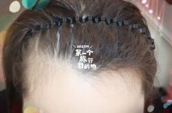 -大麦微针植发全国连锁