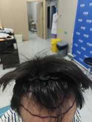 -碧莲盛不剃发植发