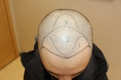 -大麦微针植发丨全国连锁