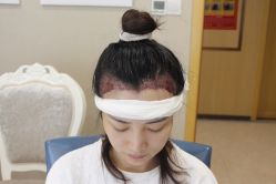 -大麦微针植发丨全国连锁