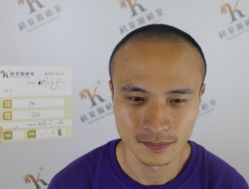 -大麦微针植发丨全国连锁