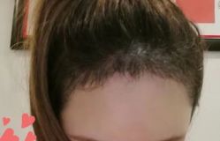 -大麦微针植发丨全国连锁