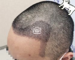 -大麦微针植发全国连锁