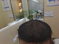 -碧莲盛·不剃发植发