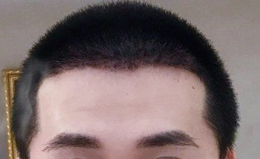 -大麦微针植发丨全国连锁