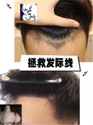 -大麦微针植发全国连锁