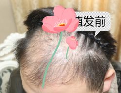 -大麦微针植发全国连锁