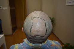 -大麦微针植发全国连锁