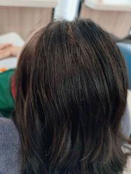 -大麦微针植发丨全国连锁