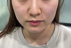 体验后-洁铭新加坡医美