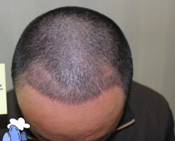 -大麦微针植发丨全国连锁