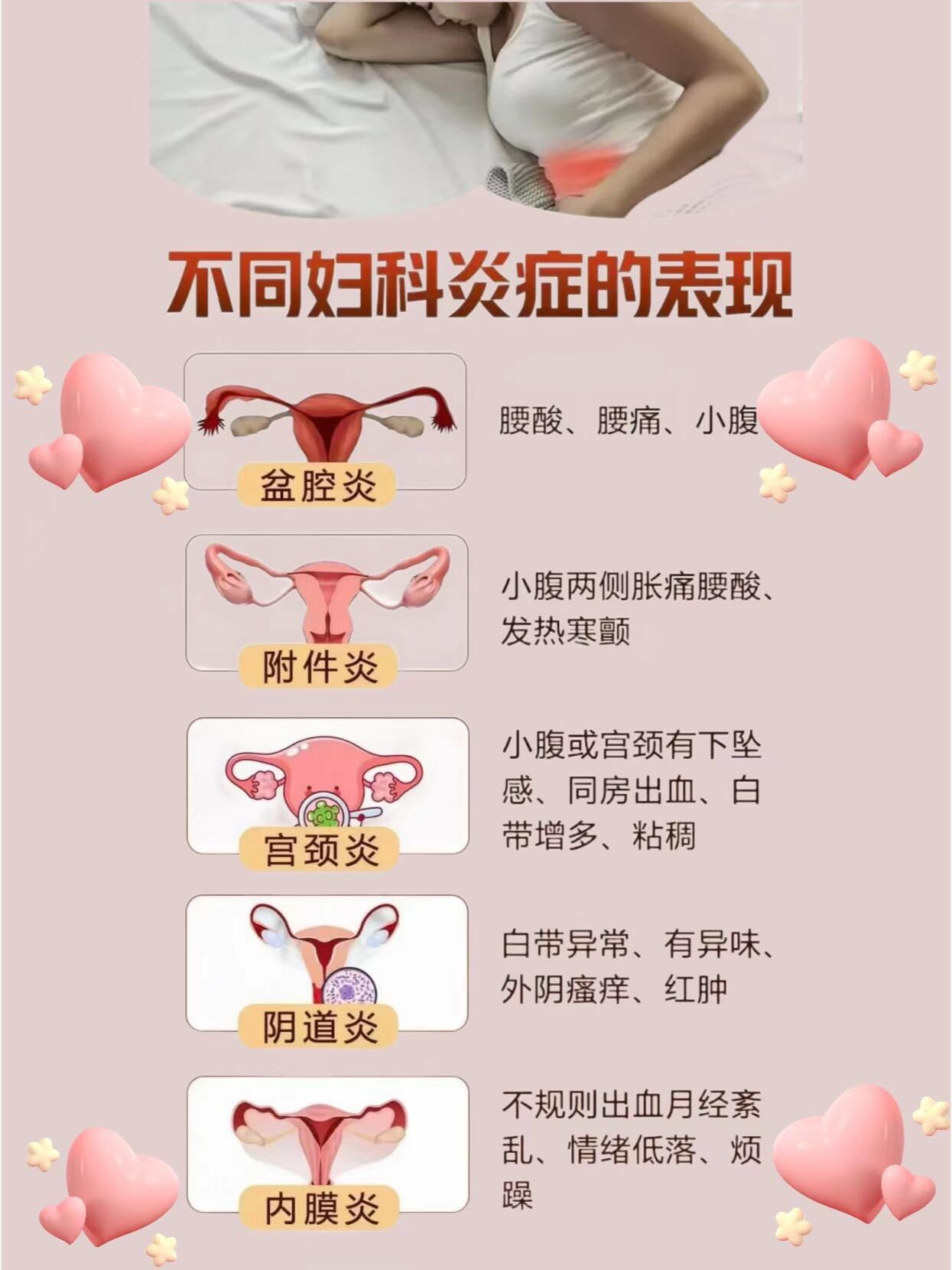 不同的妇科炎症表现