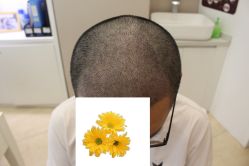 -大麦微针植发丨全国连锁