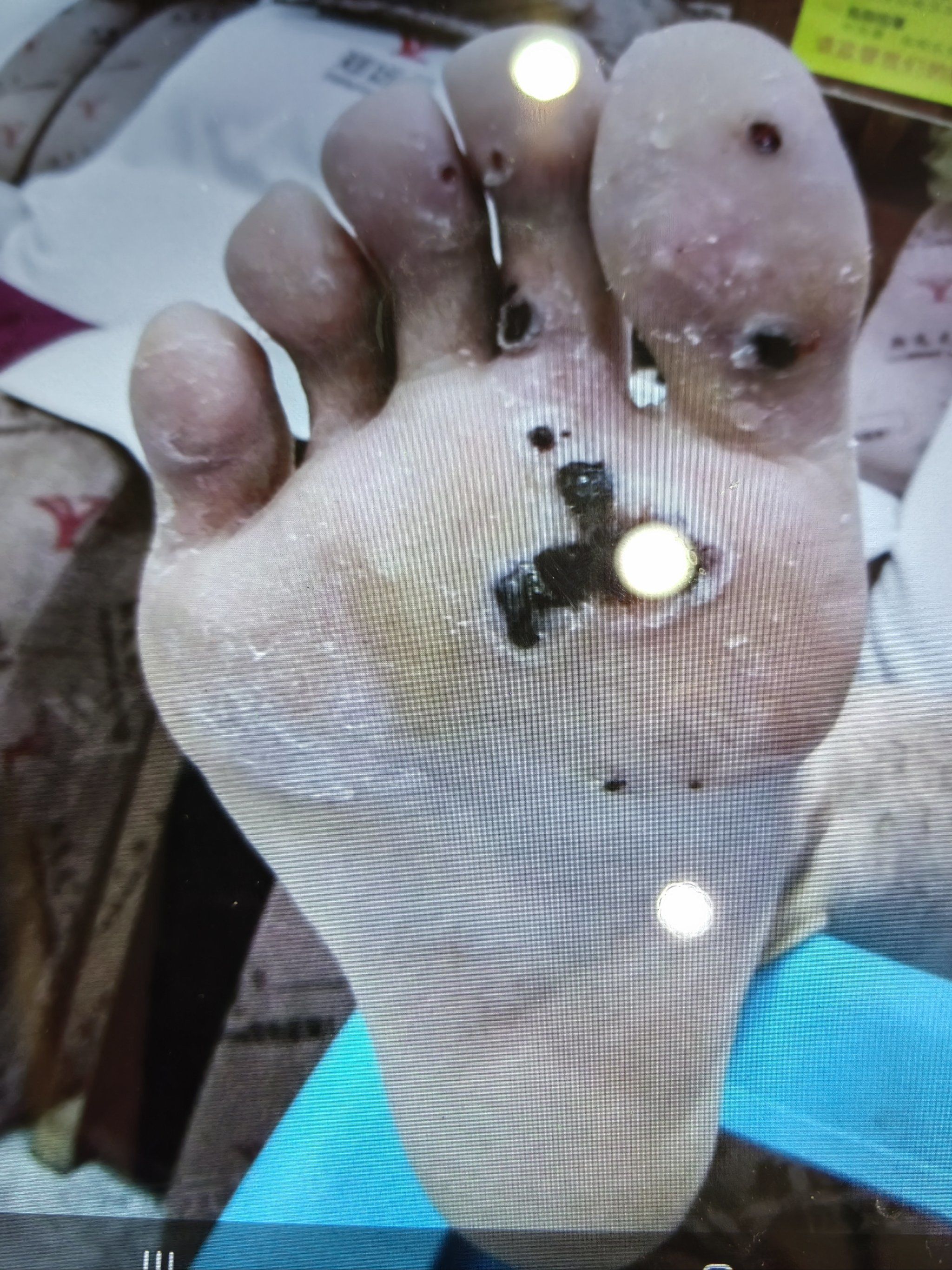 血胞刺康复率前后的一个对比图片