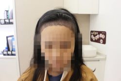 -大麦微针植发全国连锁