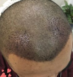 -大麦微针植发丨全国连锁