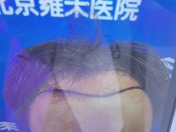 -北京雍禾植发医院