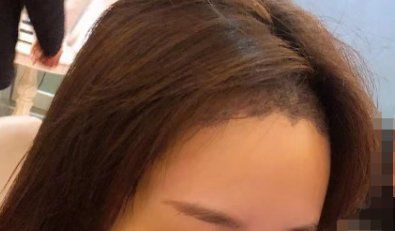 -大麦微针植发全国连锁