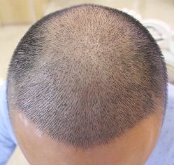 -大麦微针植发丨全国连锁