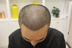 -大麦微针植发丨全国连锁