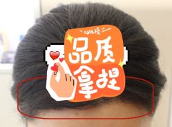 -大麦微针植发全国连锁