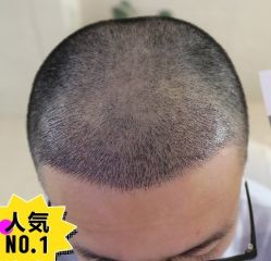 -大麦微针植发丨全国连锁