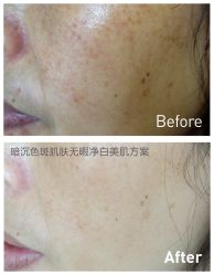 光SPA水氧+opt-光SPA科技美肤