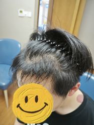 -大麦微针植发全国连锁