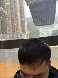 -碧莲盛·不剃发植发