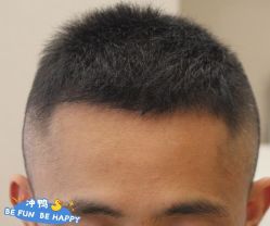 -大麦微针植发丨全国连锁