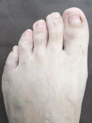 基本长好-派恩宜灰指甲鸡眼嵌甲手足癣