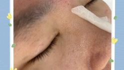 体验前-skin79皮肤管理中心