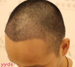 -大麦微针植发丨全国连锁