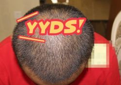 -大麦微针植发丨全国连锁