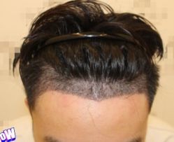 -大麦微针植发丨全国连锁