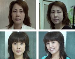 脸部拉皮价格-新雅韩整形美容医院