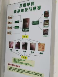 -德哥灰指甲脚气甲沟炎跖疣护理
