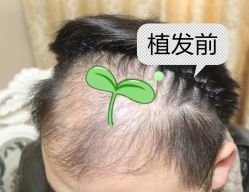 -大麦微针植发全国连锁