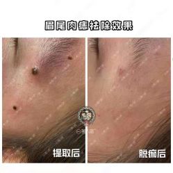 -美人痣全国连锁
